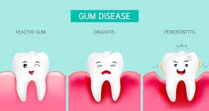 gum disease