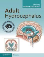 hydrocephalus