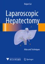 laparoscopic hepatectomy: atlas and techniques