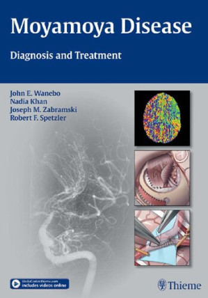moyamoya disease: diagnosis and treatment 1st edition