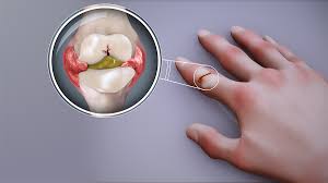 rheumatism