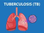 tuberculosis