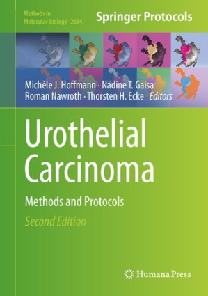 urothelial carcinoma