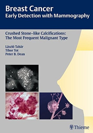 breast cancer early detection with mammography crushed stone like calcifications the most frequent malignant type