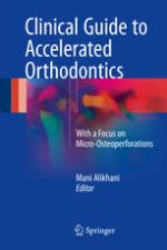 clinical guide to accelerated orthodontics with a focus on micro osteoperforations