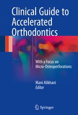 clinical guide to accelerated orthodontics with a focus on micro osteoperforations
