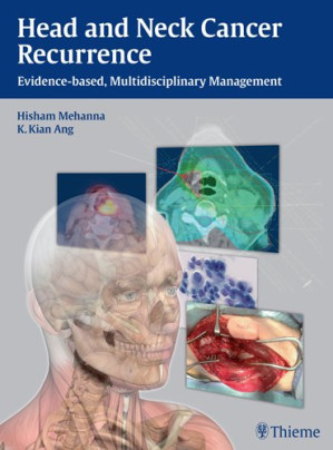head and neck cancer recurrence evidence based multidisciplinary management