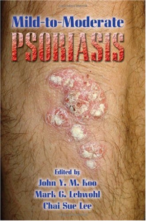 mild to moderate psoriasis