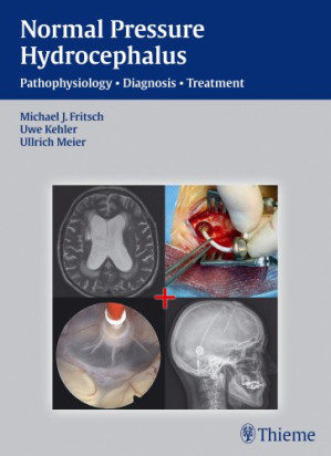 nph normal pressure hydrocephalus pathophysiology diagnosis treatment
