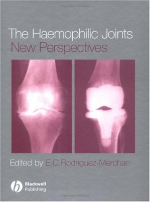 the haemophilic joints new perspectives