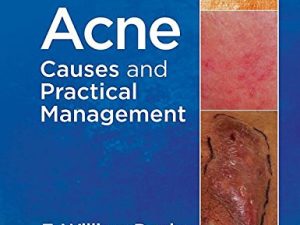 acne causes and practical management 2015 release