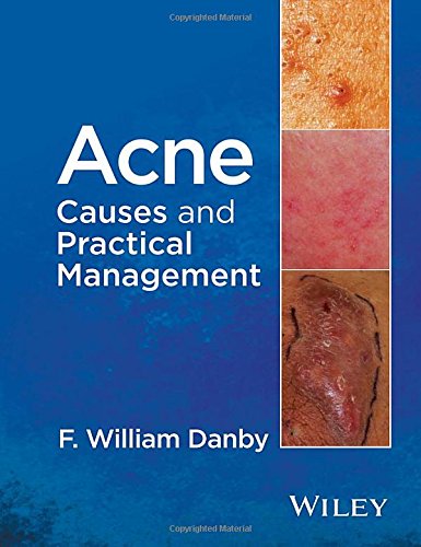 acne causes and practical management 2015 release