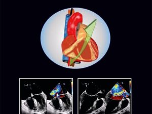 atlas of transesophageal echocardiography 2 edition