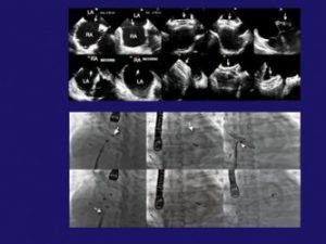 complications during percutaneous interventions for congenital and structural heart disease 1st edition